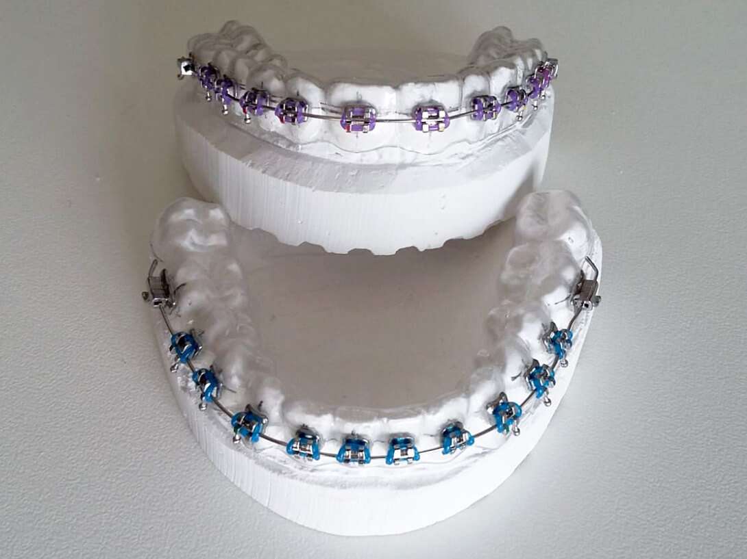 Clear Retainer with Brackets | Fake Braces | Special Appliances ...